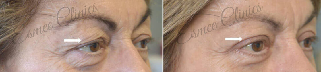 Before and After img